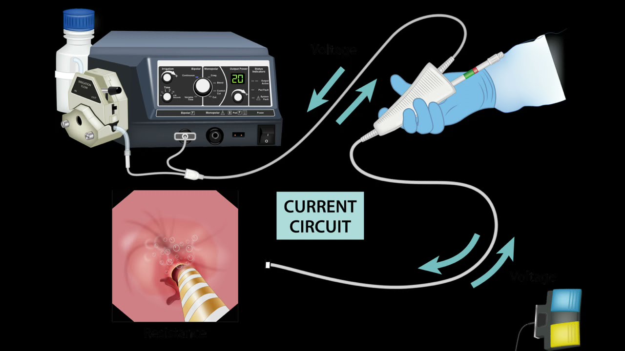 HCC 1472-Lesson-11b3-Hemostatic Devices  Bipolar device