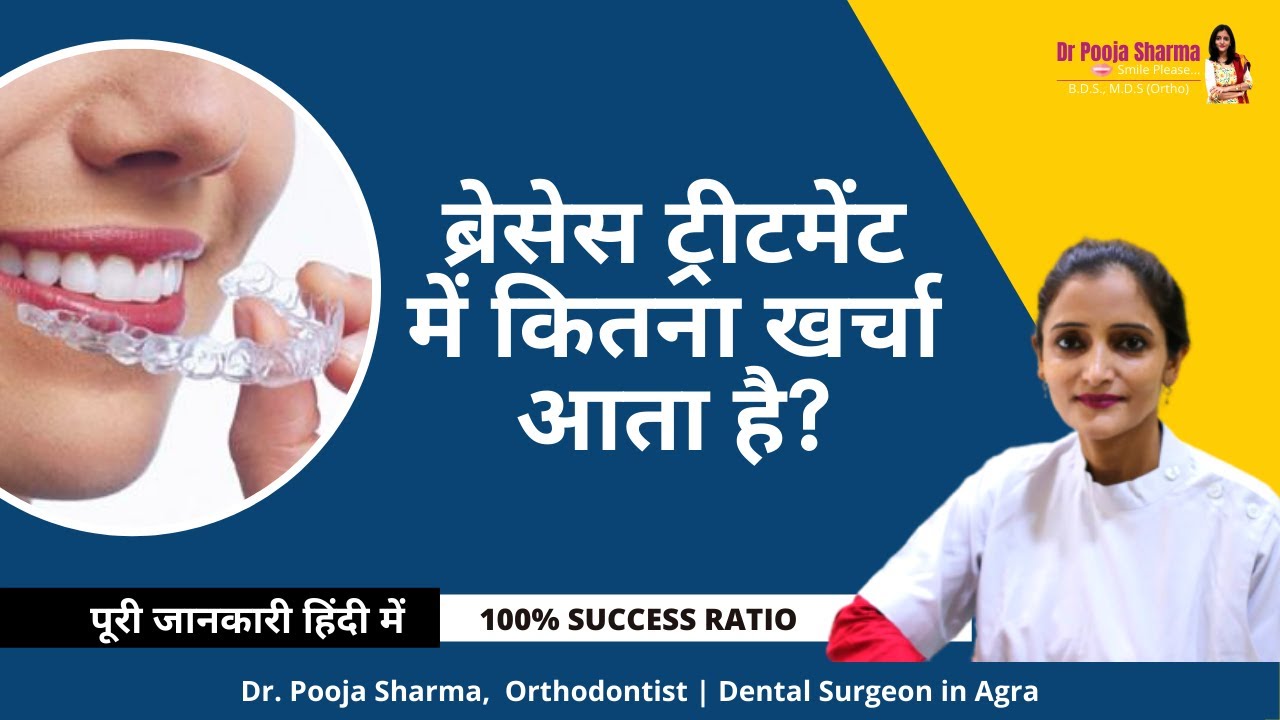 Cost of Braces Treatment in Agra, India | Smile Makeover Cost - Dr. Pooja Sharma - Orthodontist