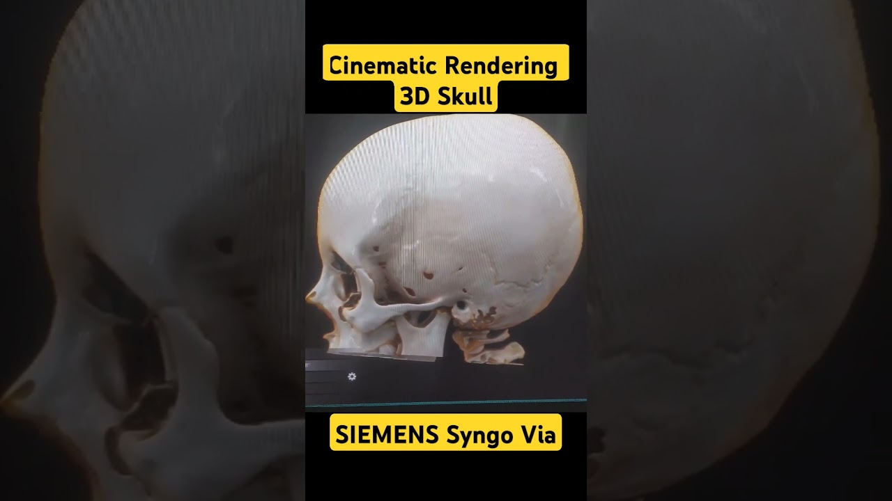 3D Cinematic Rendering of skull। SIEMENS SYNGO VIA। CT Scan of Head।
