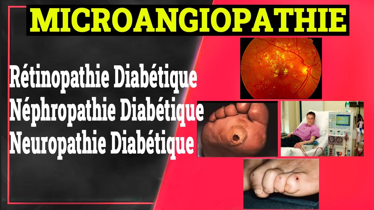 Complications Chroniques du Diabète: Microangiopathie Diabétique | Endocrinologie Medicale
