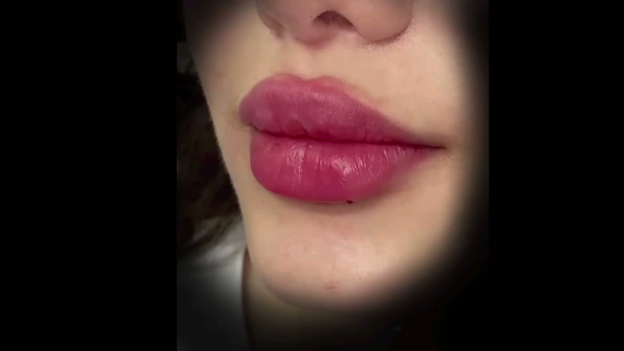 Xtreme lip overgrowth! (528 Hz) - by Rubye