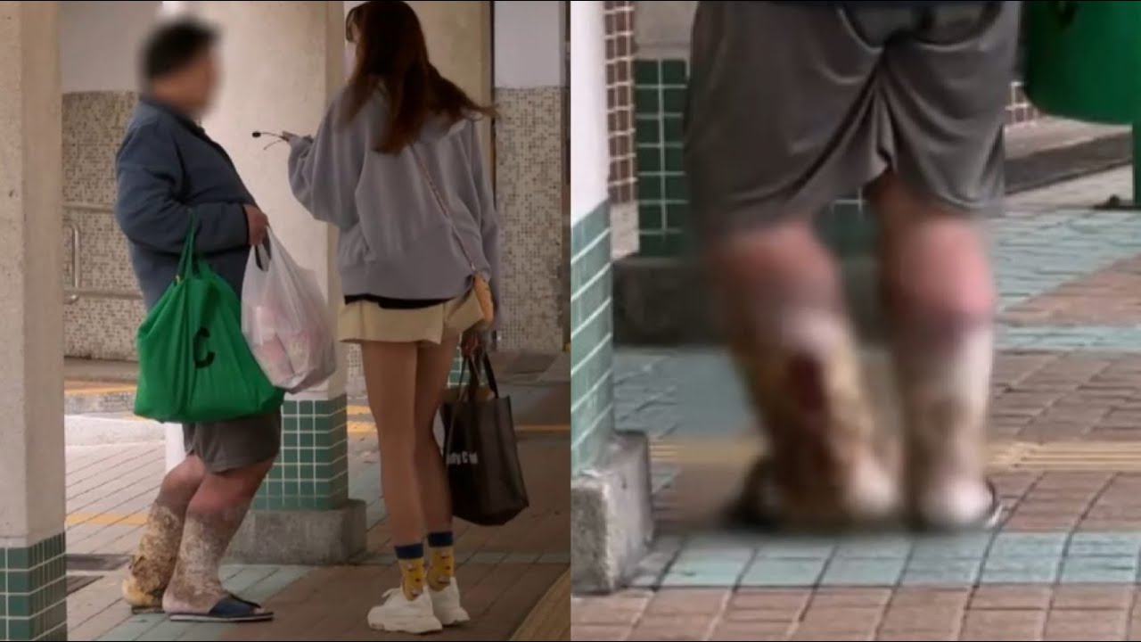 黃大仙上邨街坊被臭味滋擾  男子雙腿腫脹皮爛有血水滲出