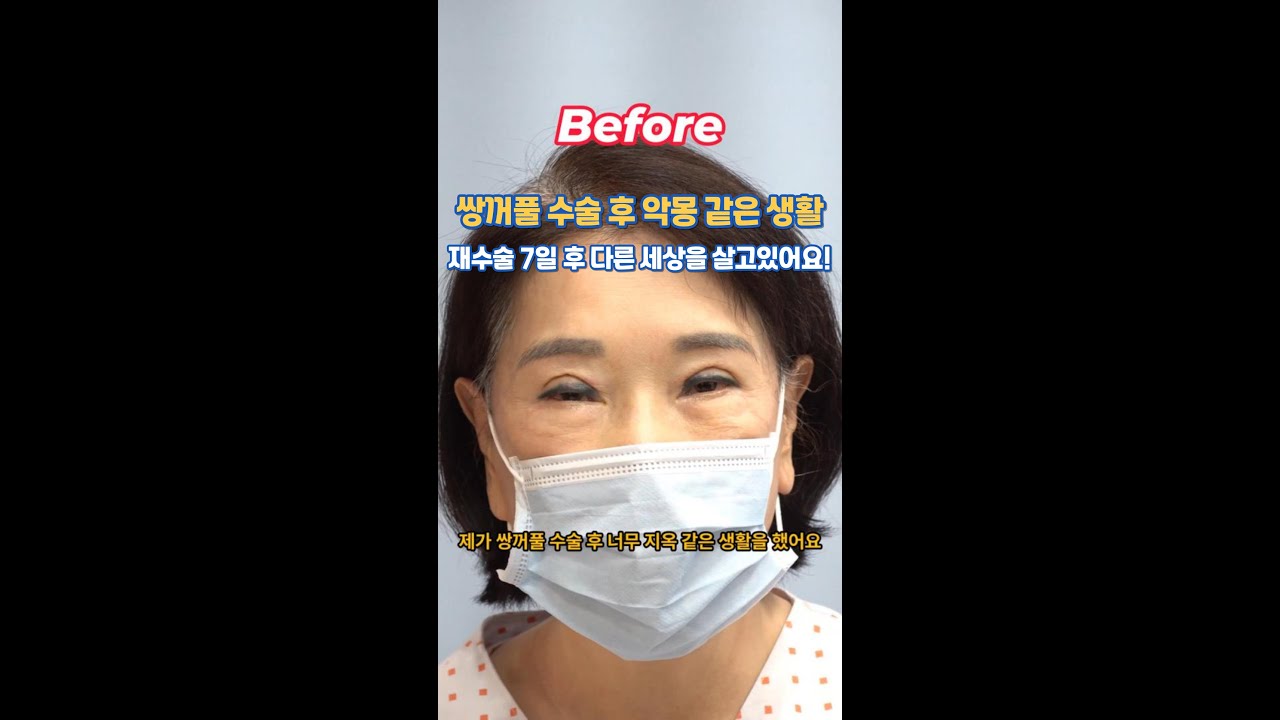 쌍꺼풀 수술 후, 지옥 같은 나날.. 그런데 쌍꺼풀재수술 7일 만에 기적이?
