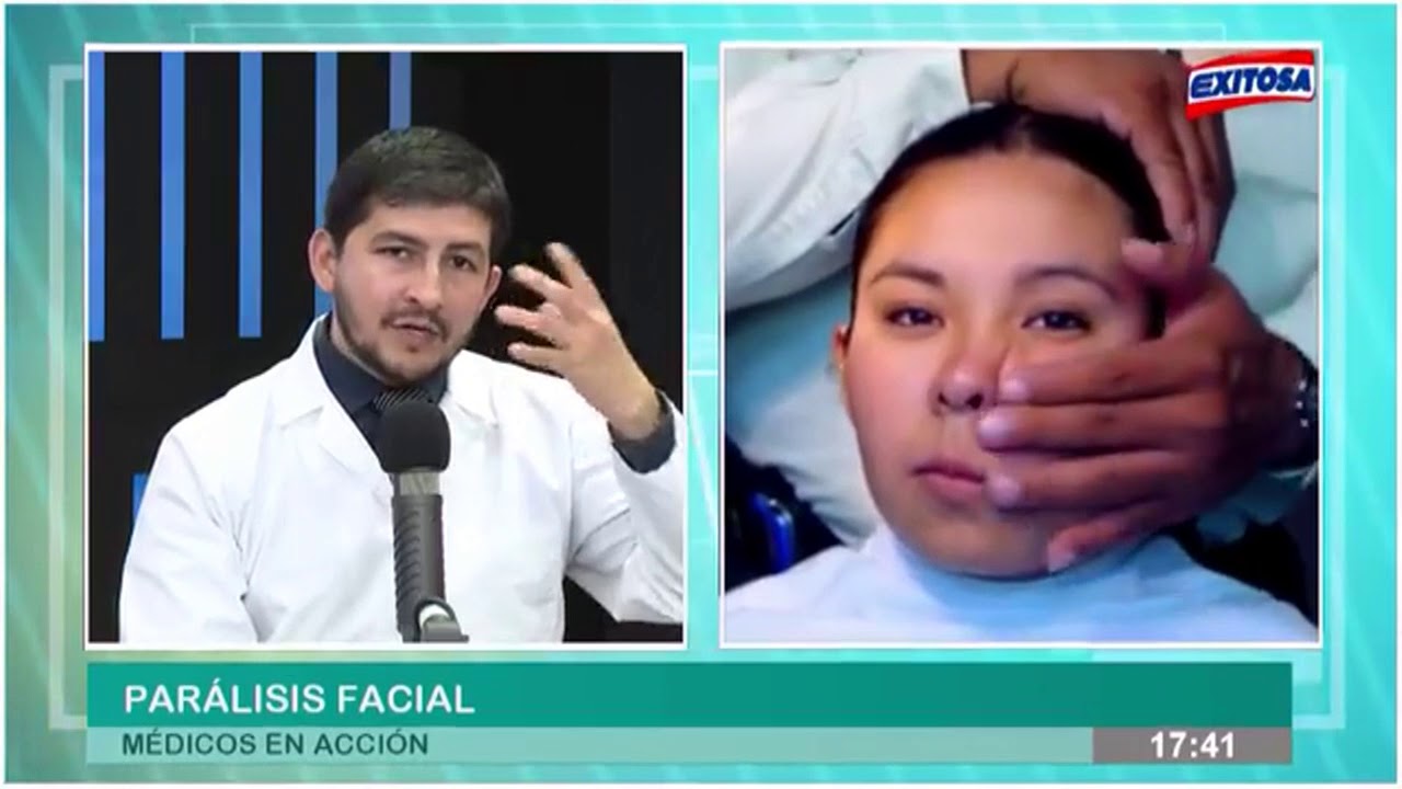 Parálisis facial