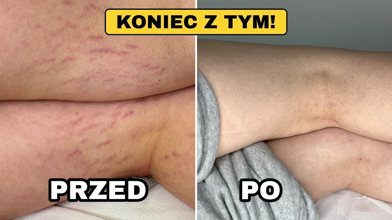Jak pomogliśmy pacjentce pozbyć się rozstępów w 4 zabiegach