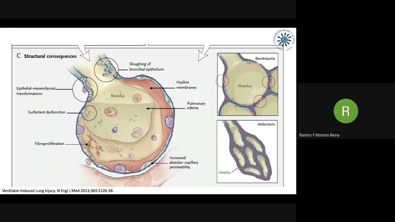 PODER MECANICO. ¿Un cálculo factible para ventilación protectora a la cabecera del paciente?