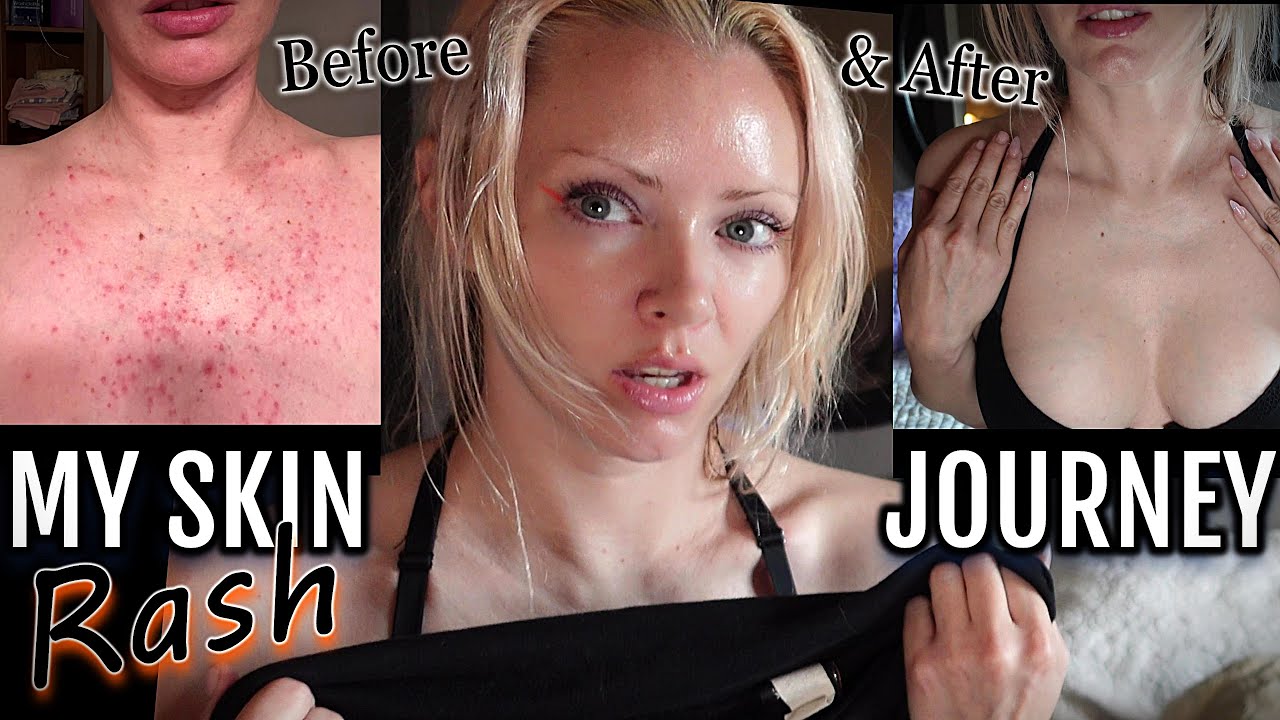 SKIN JOURNEY: rash went undiagnosed for years | folliculitis infection & treatment (before & after)