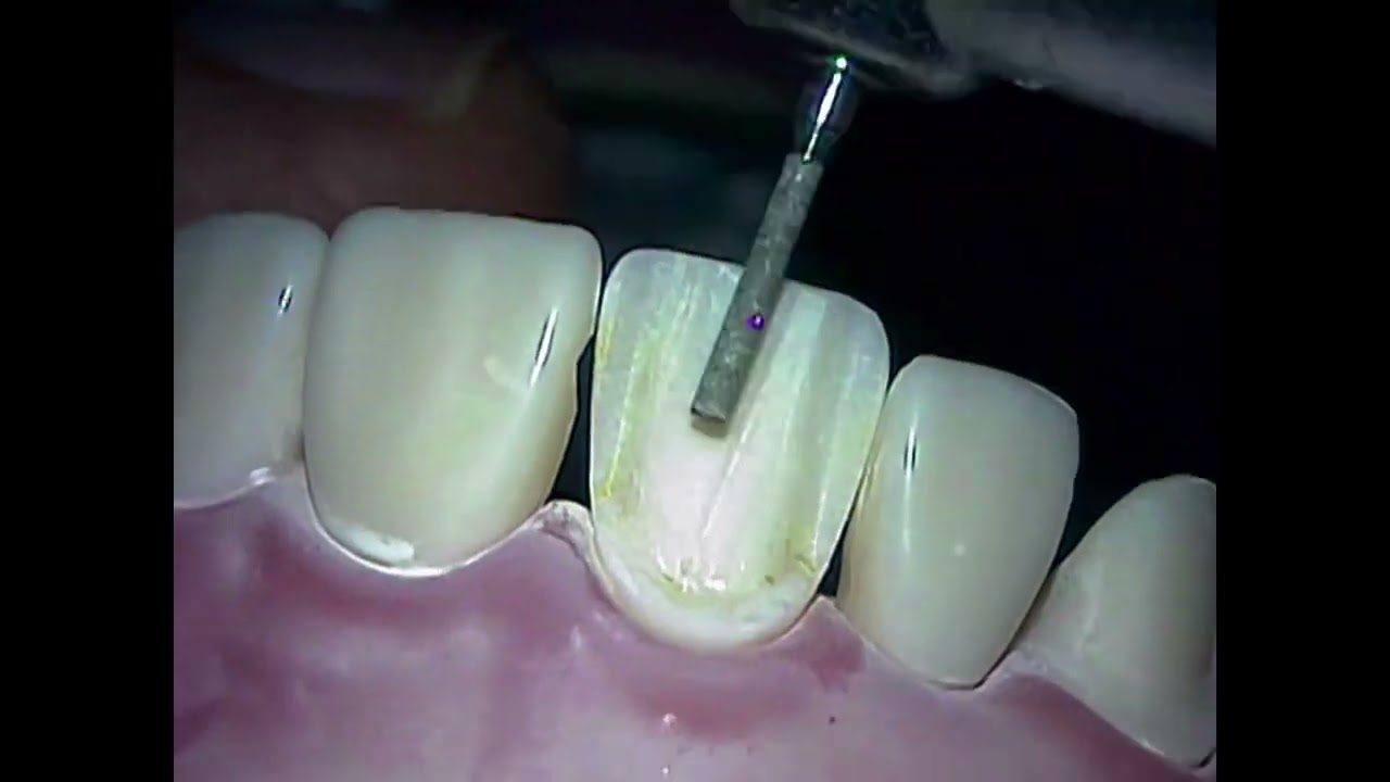 Teaching Dentistry;  DugganOralDesign.com.  6-12.  The PFM - Mx central demo