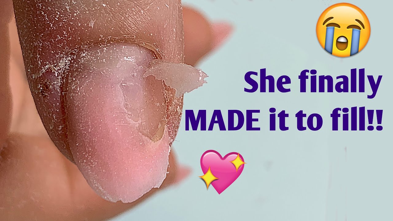 Anna Never Made it This FAR - 3 weeks, no broken nails! | Bitten Nails Fill