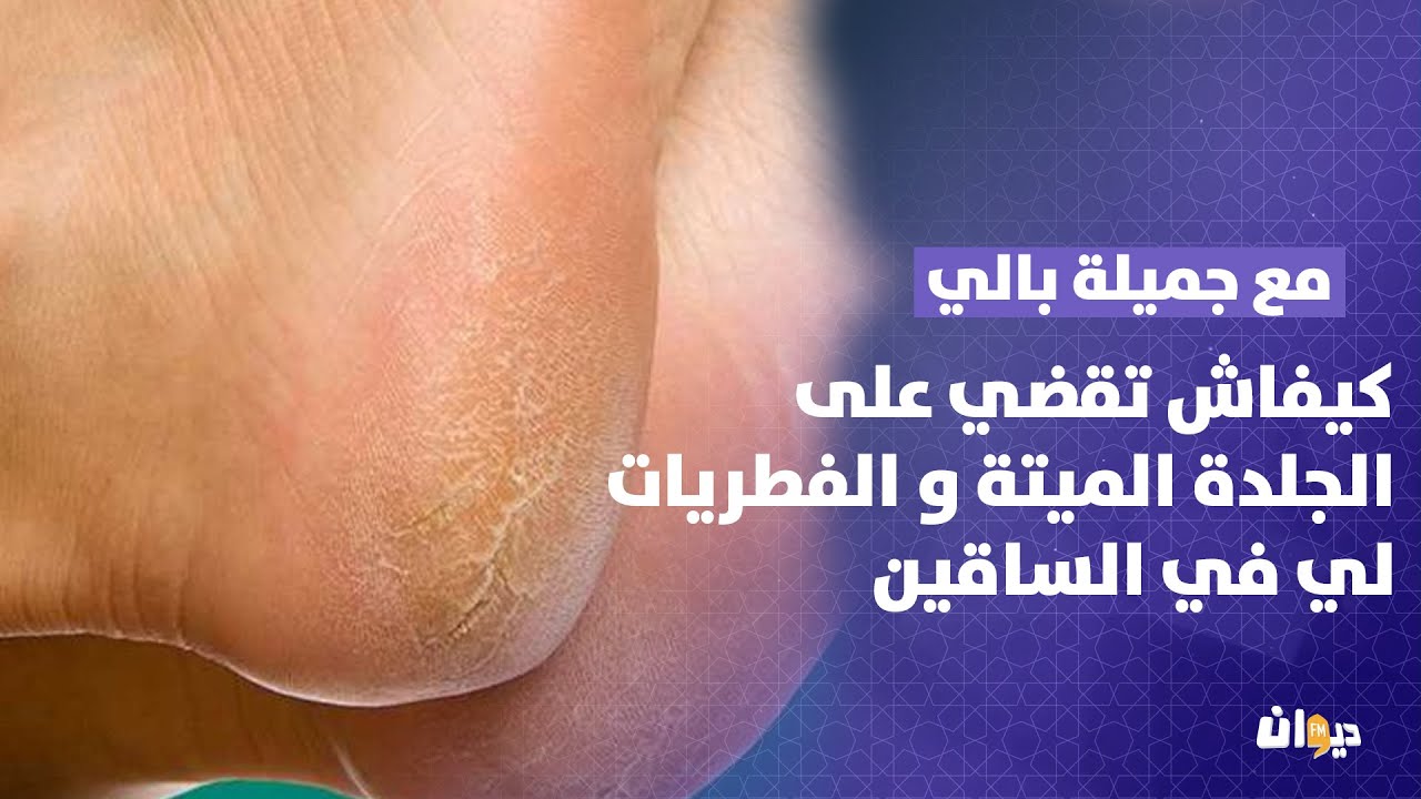 كيفاش تقضي على الجلدة الميتة  و الفطريات لي في الساقين
