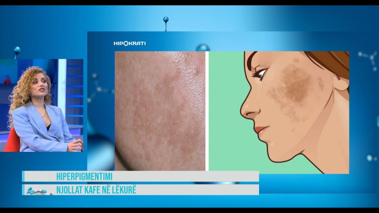 Hipokrati – Si të hiqni njollat kafe dhe shenjat në fytyrë, flet dermatologia