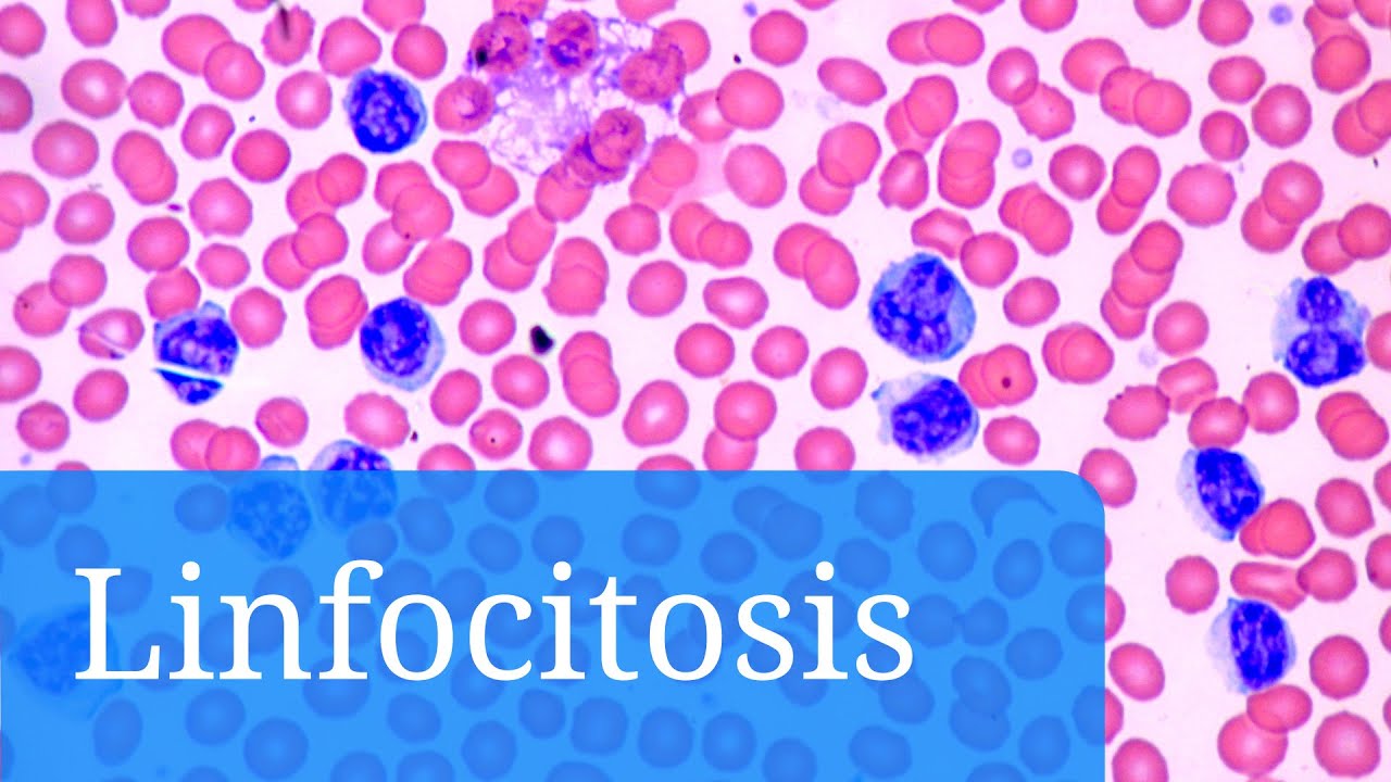 Linfocitosis: qu&eacute; indican los linfocitos altos