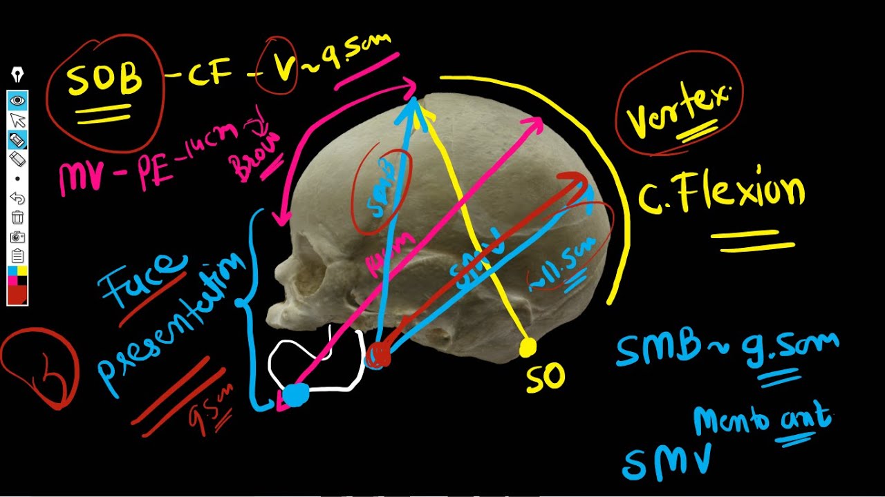 Fetal Skull Diameters - Diameters of engagement