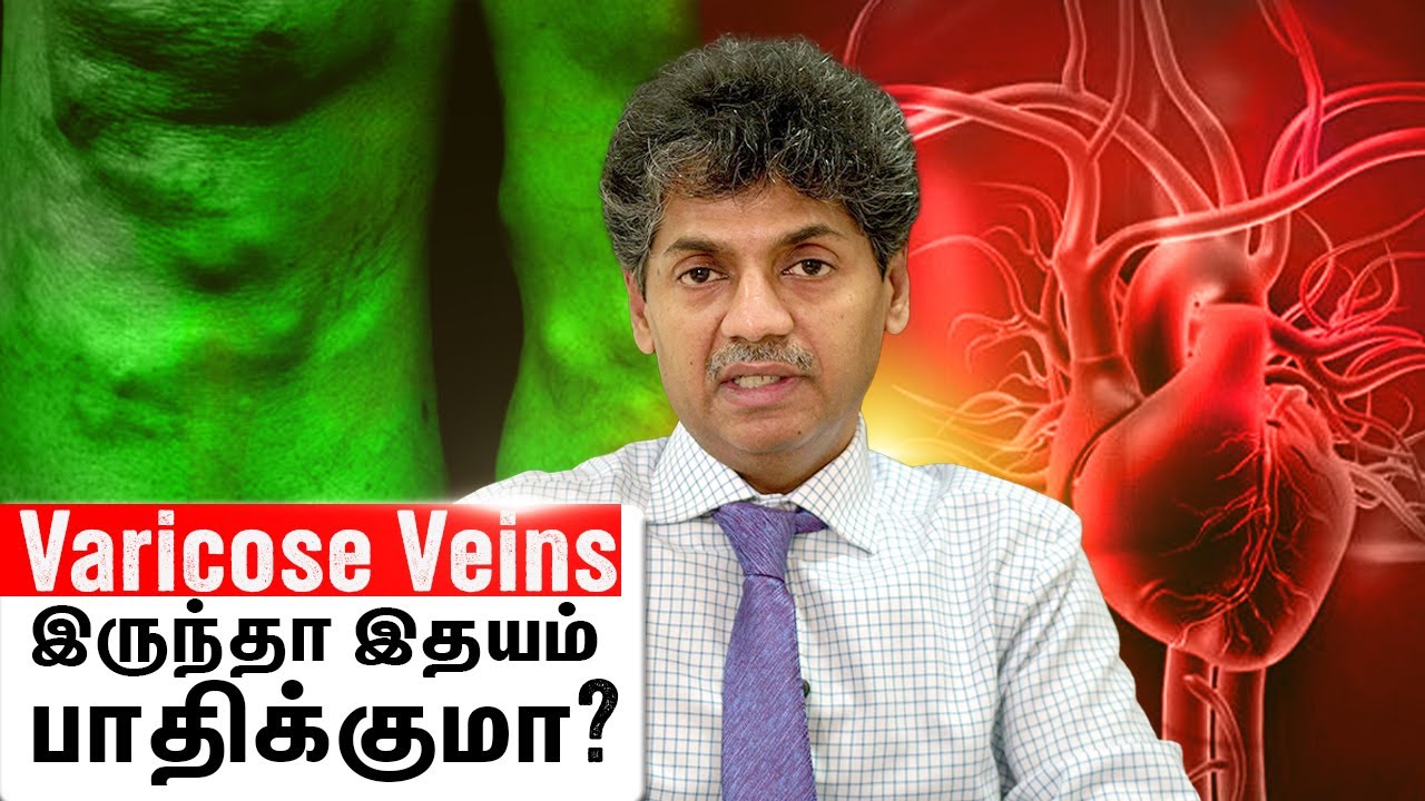 varicose veins இருந்தா, இதயம் பாதிக்குமா? | Dr Balakumar