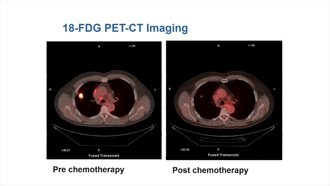 Oxford University surgical lectures: Effect of metformin on breast cancer metabolism