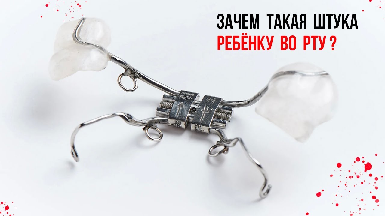 Расширение верхней челюсти у ребёнка [что очень важно знать‼️]