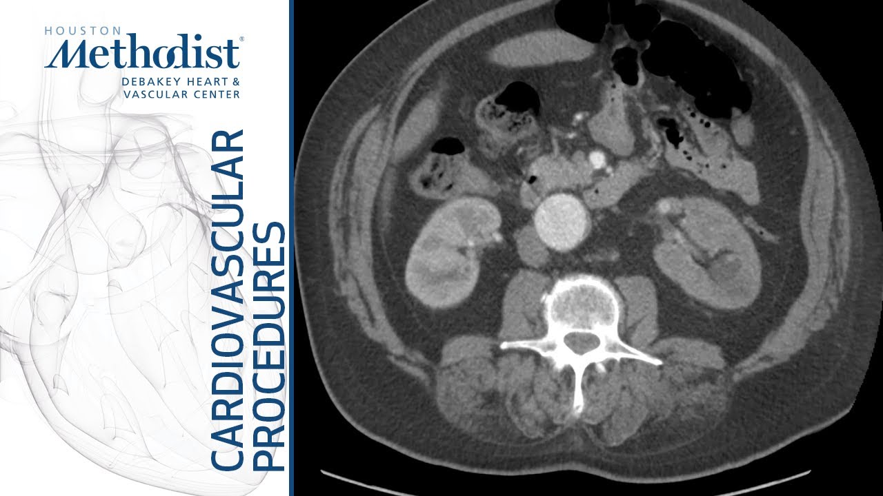 Conformable Thoracic Endoprosthesis Implantation (Alan B. Lumsden, MD)
