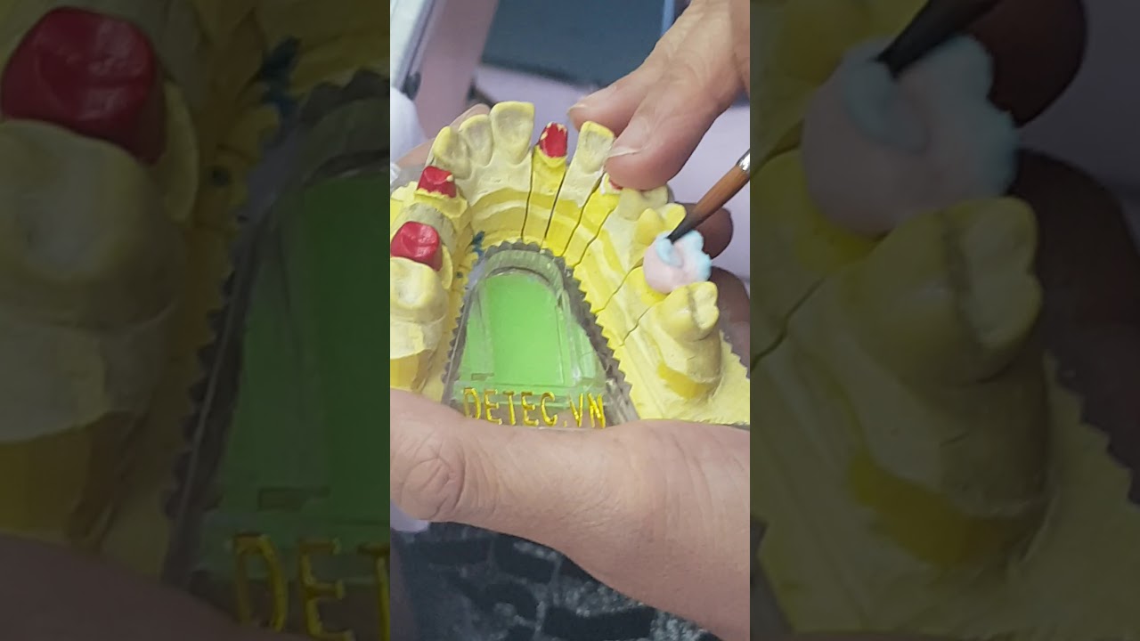 Đắp sứ răng 6 hàm trên