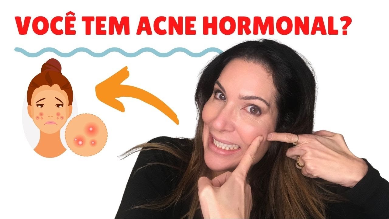 Como saber se você tem ACNE HORMONAL e oque fazer para melhorar.