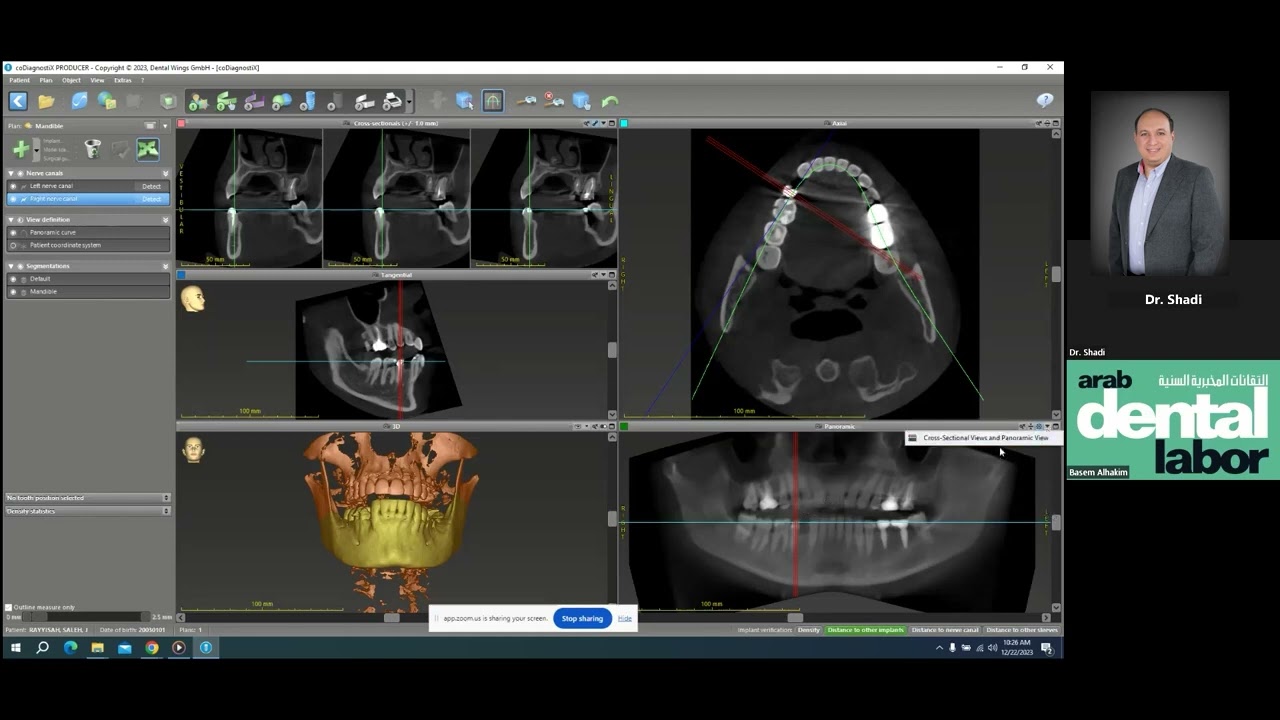 coDiagnostix Implant Surgical guide design......     Dr. Shadi Almoghayer