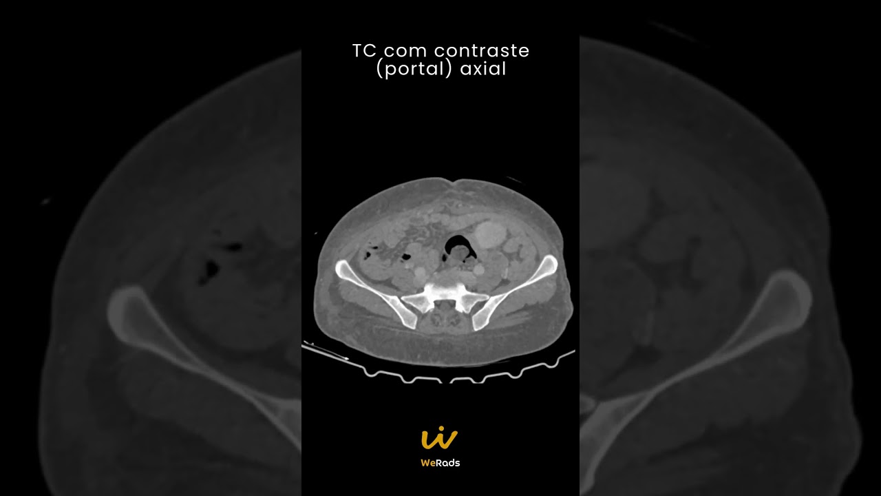 Caso do Dia - Emergência Gastrointestinal