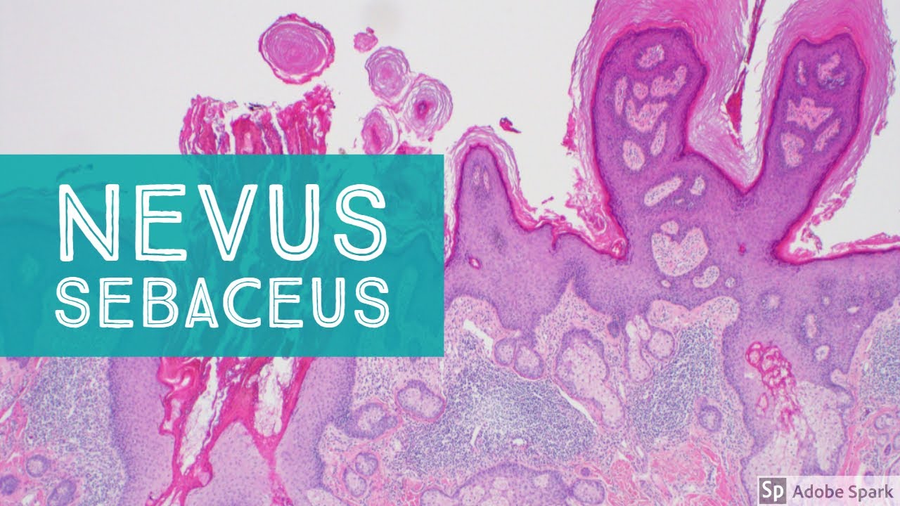 Nevus Sebaceus (not SebaceOus!)...Explained by a Dermatopathologist