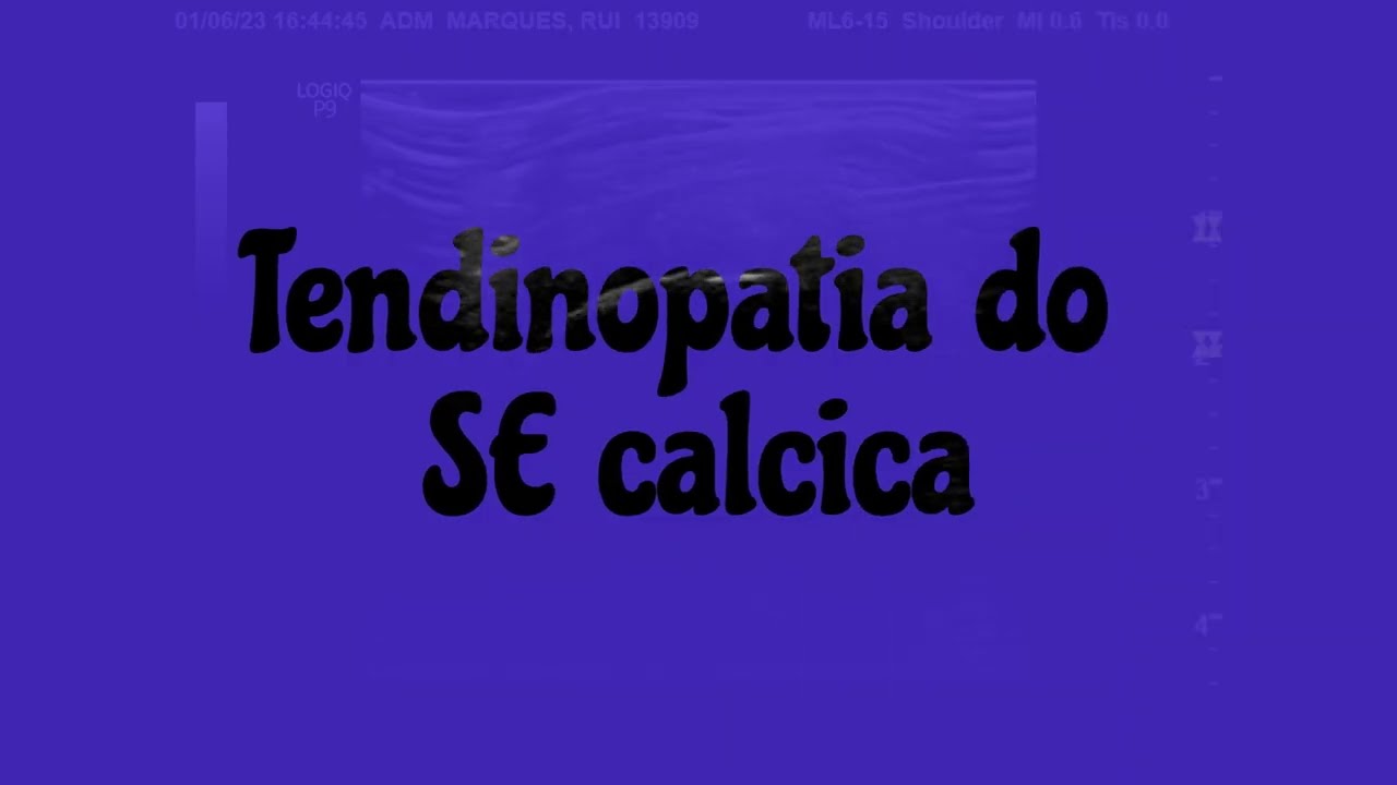 Barbotage, therapeutic technique in calcic tendinopathies (calcic supraspinatus)