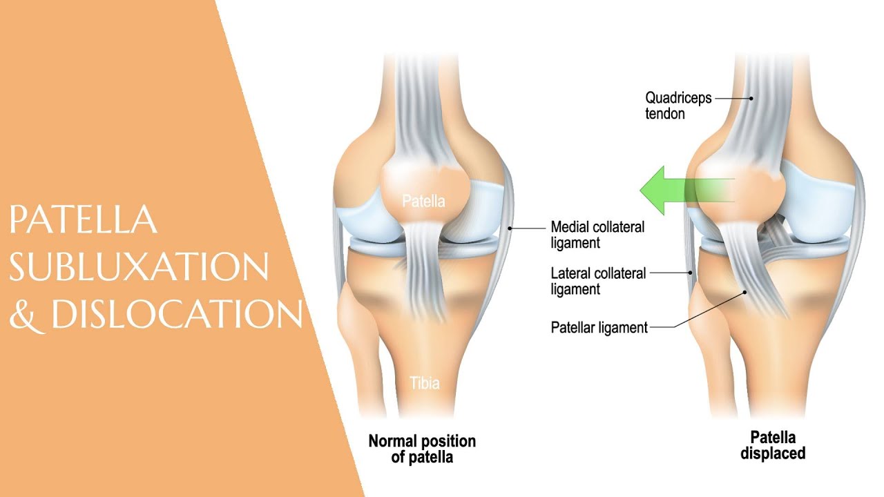 Patella Subluxation & Dislocation | Prof. Dr. Yakup YILDIRIM