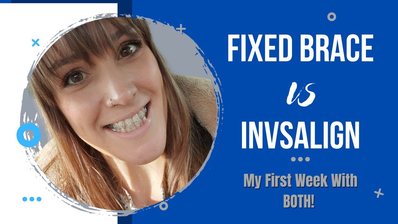 Fixed Braces VS Invisalign | My First Week In Braces | Whats It Like? Pros And Cons Of Both.