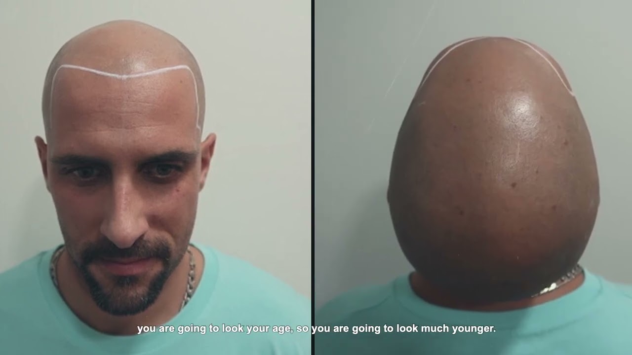 Mira el nuevo look de efecto afeitado de Juan De Dios. Un resultado natural