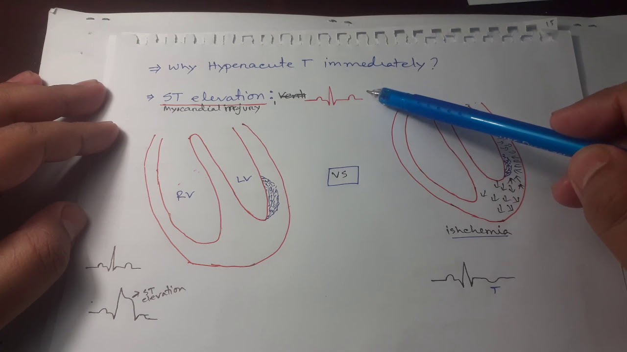 Clinical ECG Interpretation in Bangla (Part-4): Myocardial Infarction 1st part