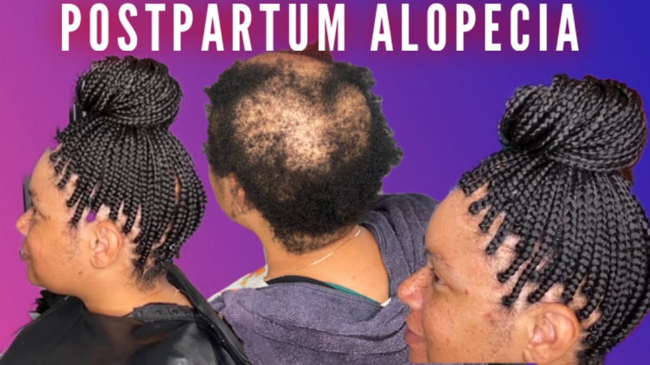 Postpartum Alopecia Box Braid Coverup