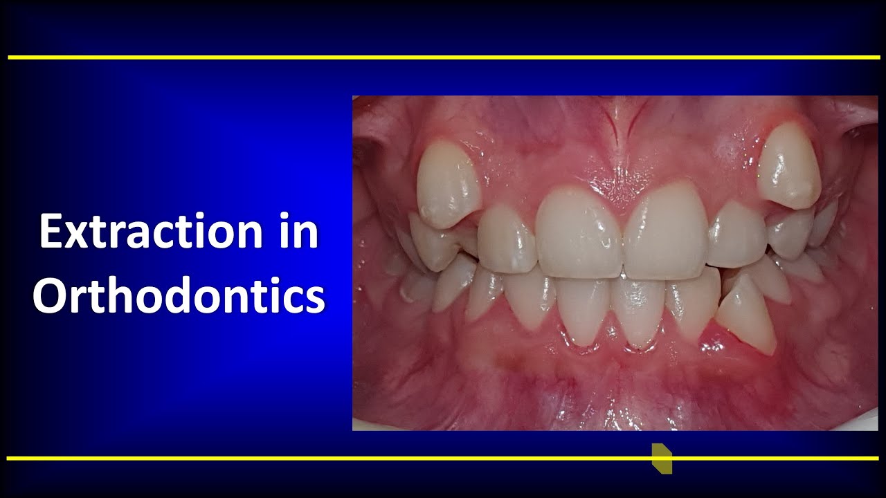 Extraction in Orthodontics