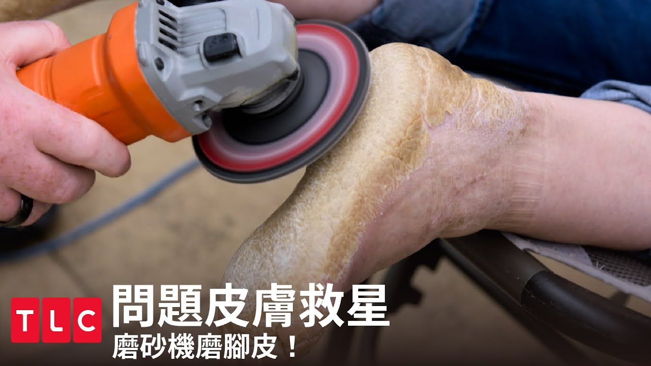 用磨砂機磨腳皮？無法痊癒的皮膚疾病😢｜問題皮膚救星｜TLC 旅遊生活頻道
