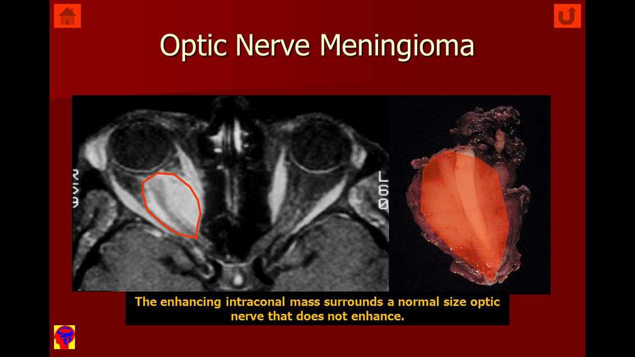 Orbit Intraconal Lesions V4b