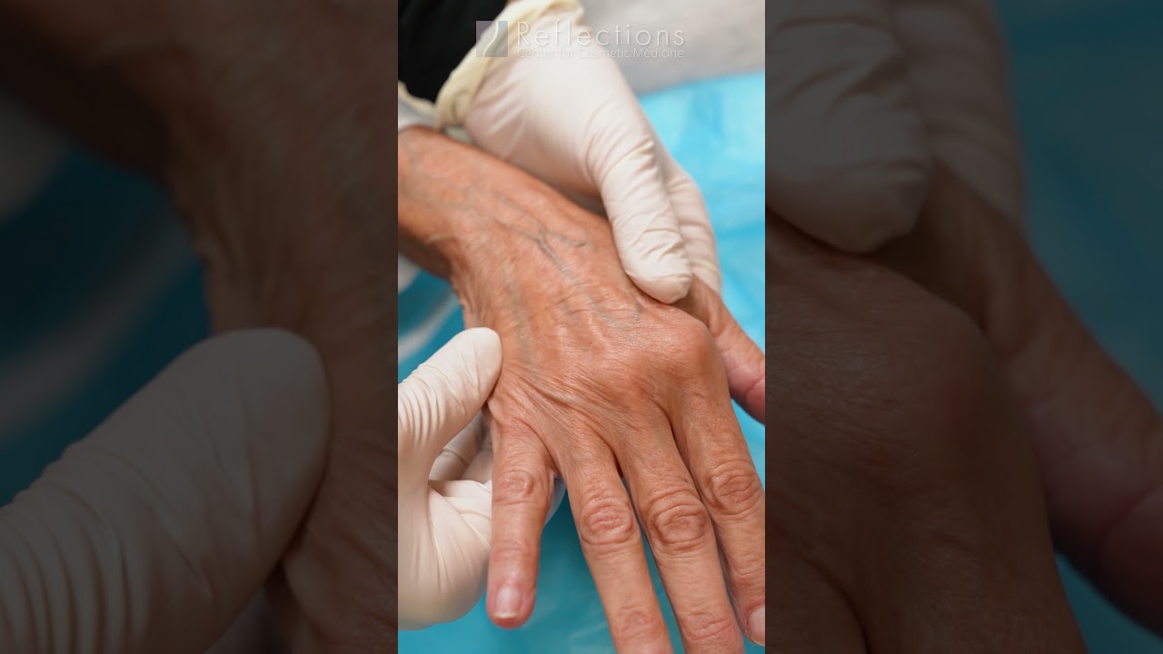 Filler for Hands
