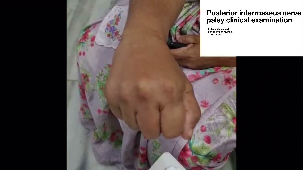 Finger drop due nerve injury clinical examination (radialnerve vs PIN palsy)@bipinhandsurgeon