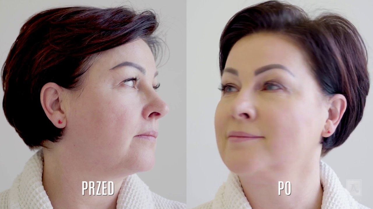 Najgłębszy lifting twarzy -  HIFU SonoQueen | Ambasada Urody Medical Spa Warszawa