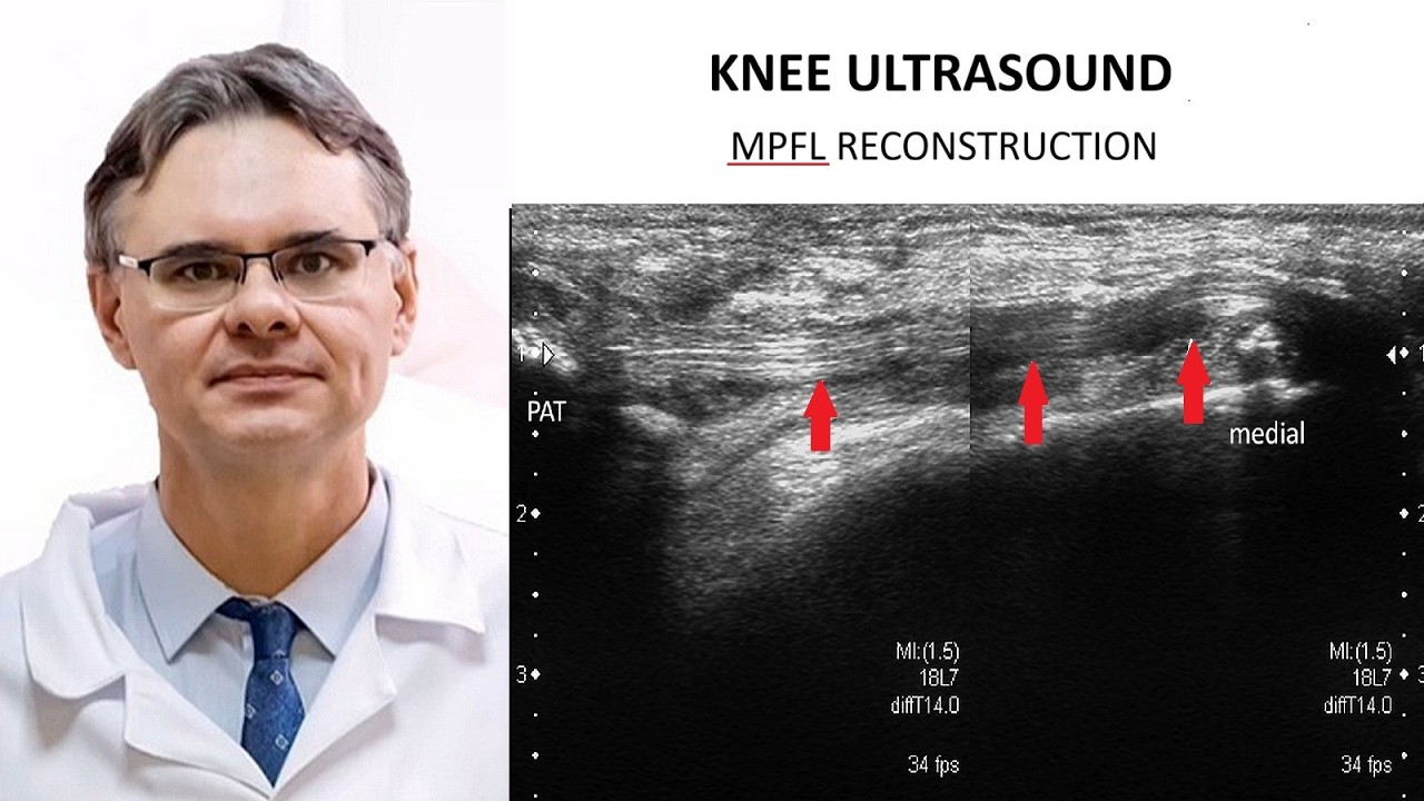 Patellar Instability and MPFL Injury – Ultrasound Assessment