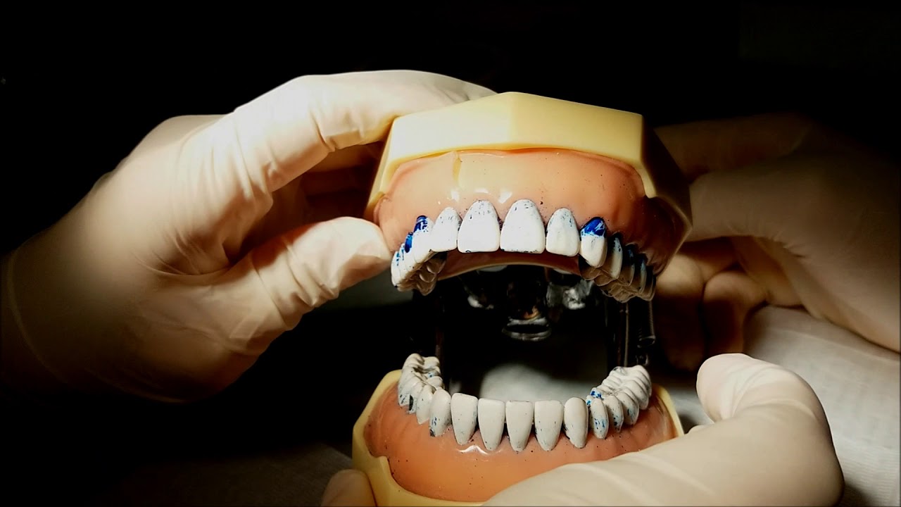 Ajuste Oclusal - Como fazer?