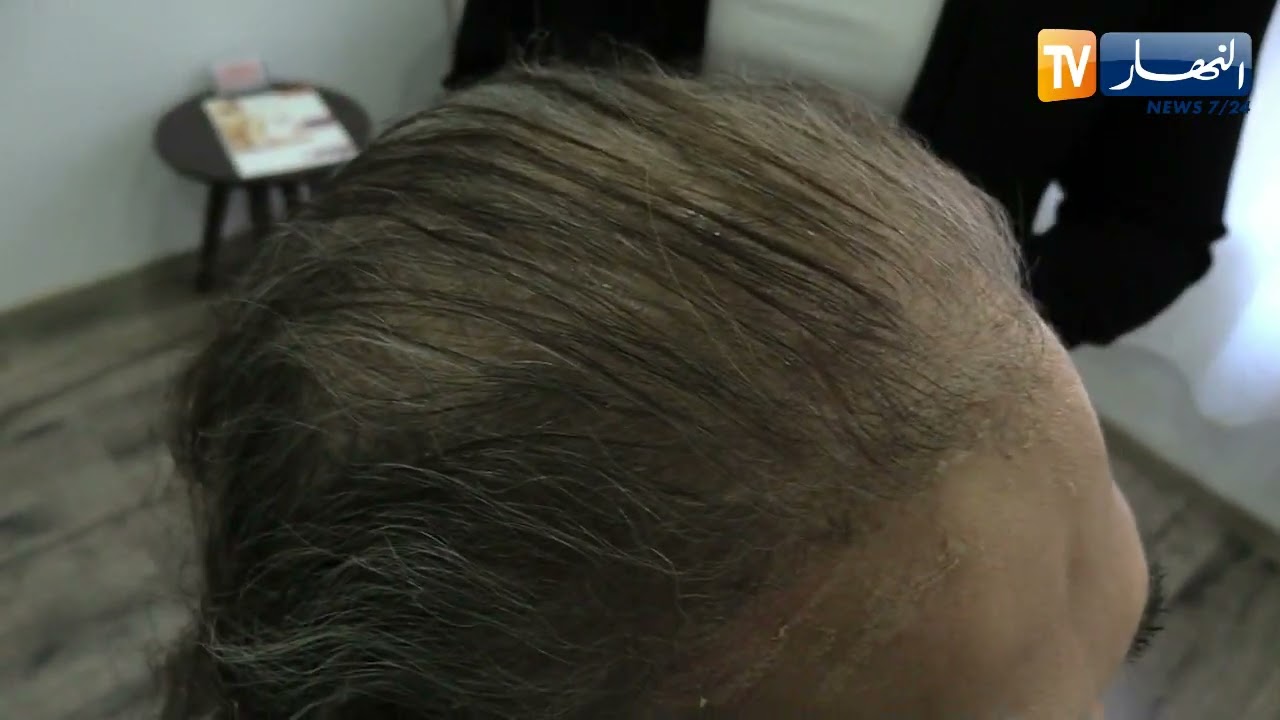 شعر مستعار طبي خاص بتساقط الشعر.. صالونات تجميل تفتح أبوابها للمرضى