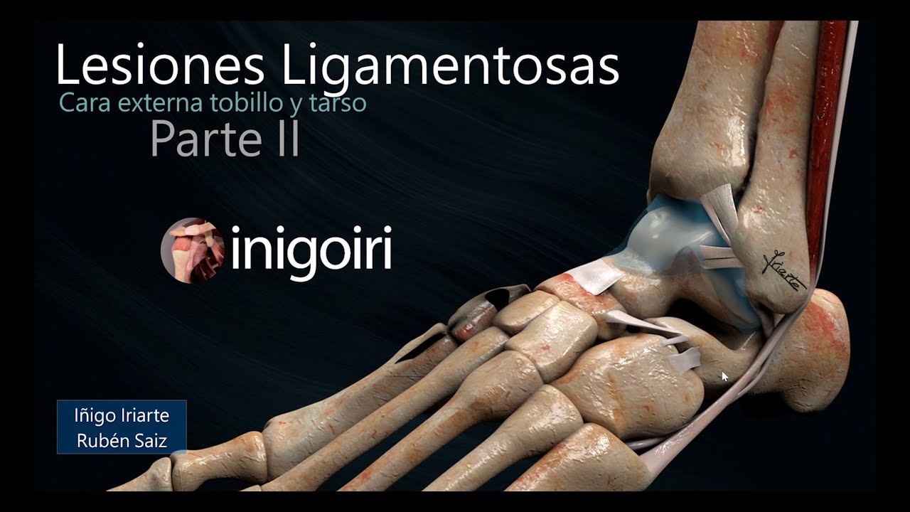 ECOGRAFÍA EN LESIONES DE LIGAMENTOS EXTERNOS DEL TOBILLO (PARTE II)