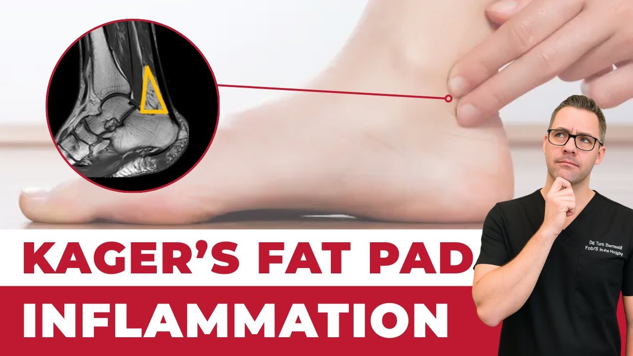 Kager's Fat Pad Inflammation and Edema Treatment