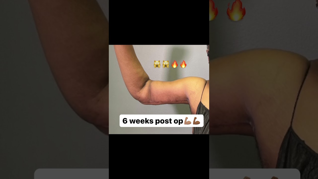 Arm lift and arm liposuction (aka brachioplasty)!💪 #brachio #armlift