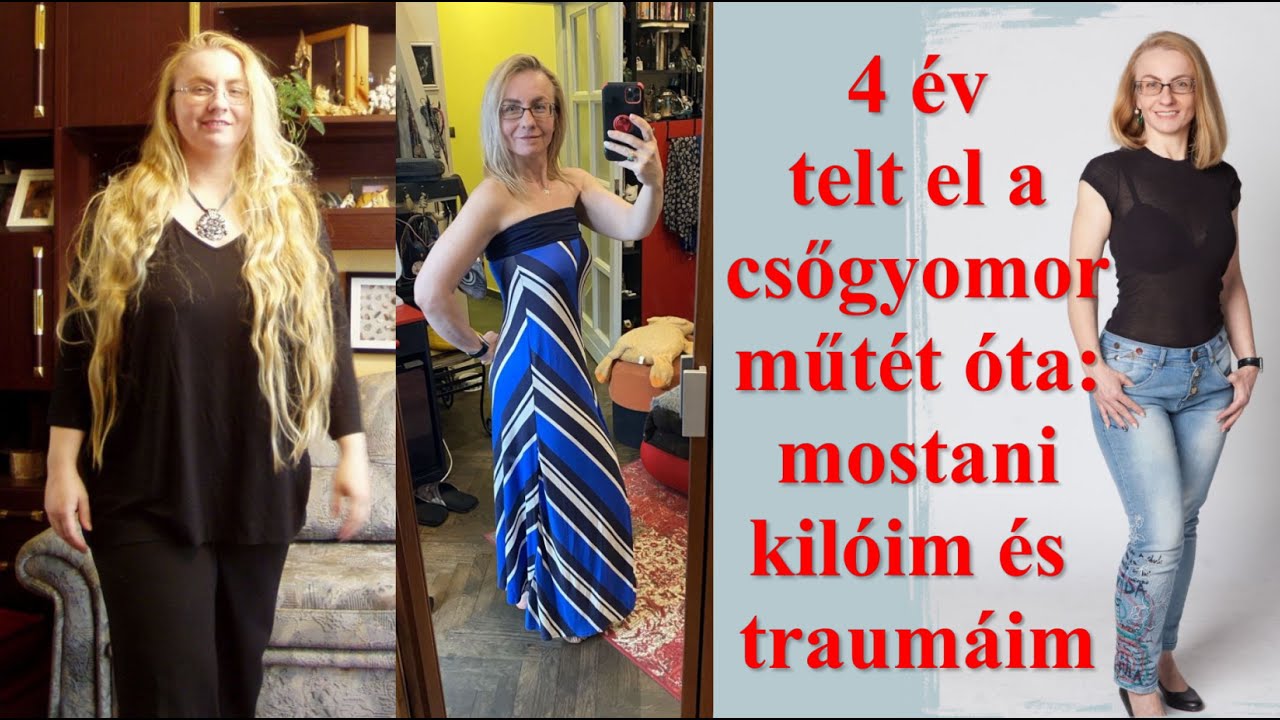 4 évvel sleeve (csőgyomor műtét) után, kilók és traumák