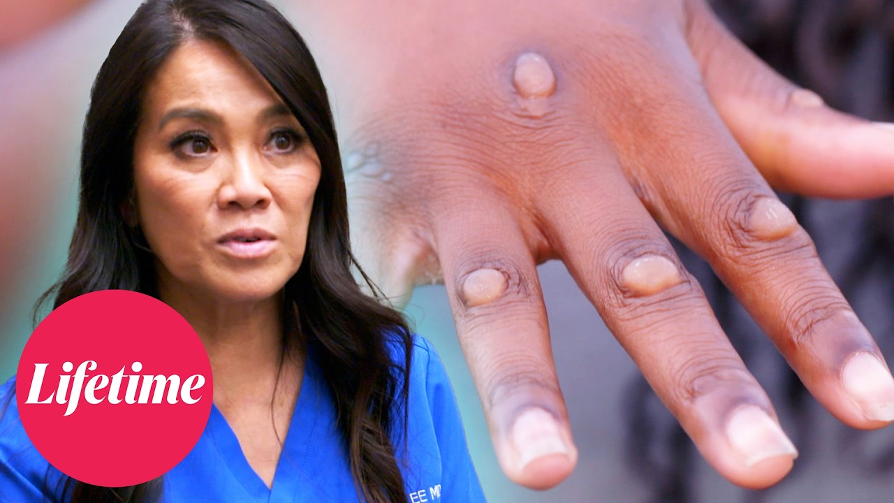 Dr. Pimple Popper: Breaking Out - MYSTERIOUS Skin Condition (S2) | Lifetime