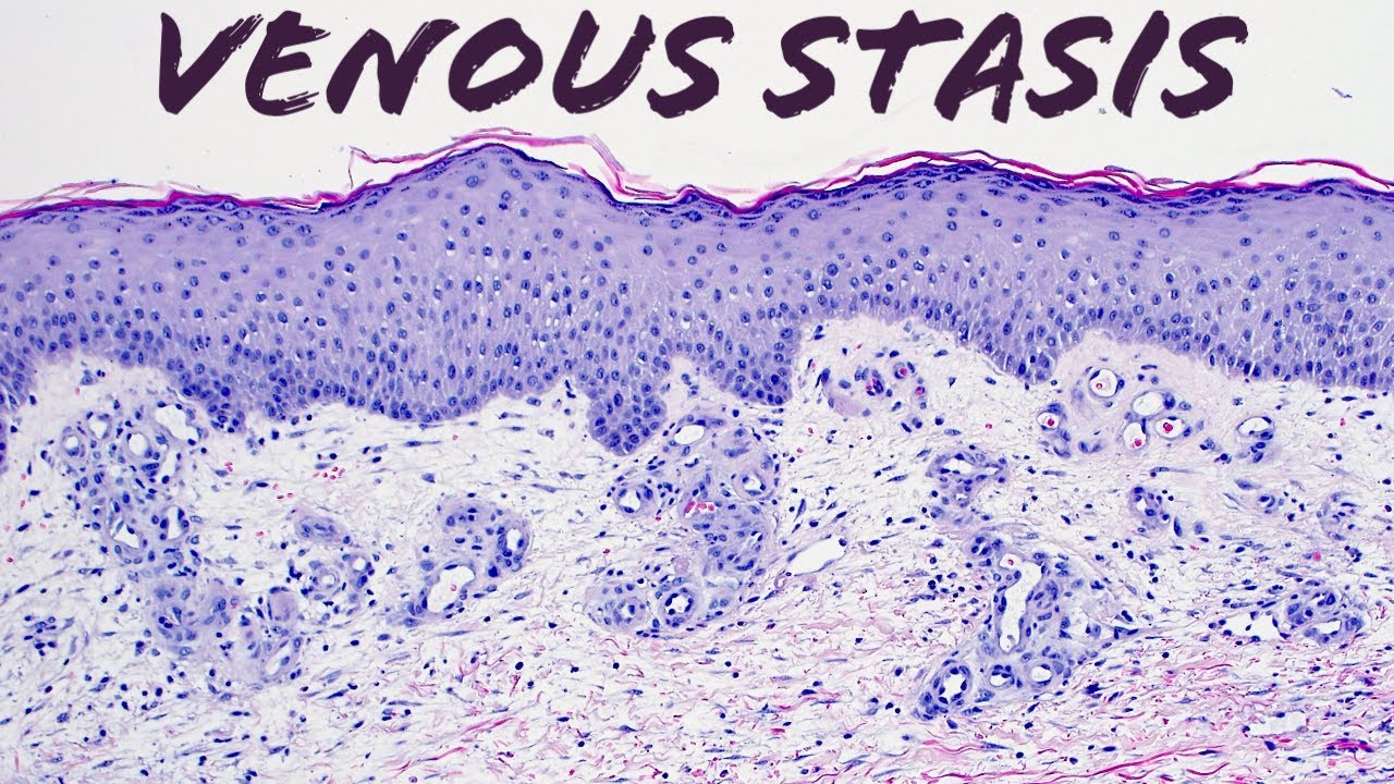 Venous stasis vascular change (pathology dermatology dermatopathology)