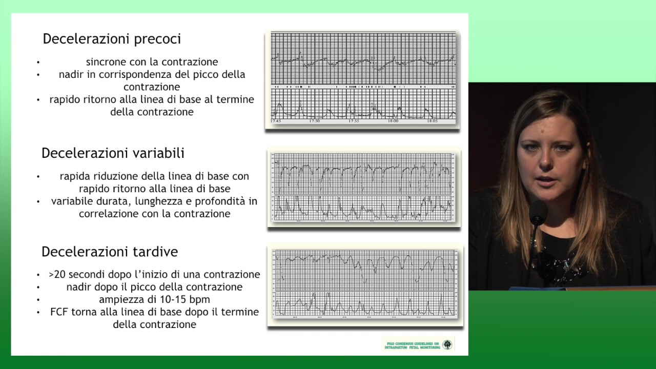 La lettura del tracciato cardiotocografico: uptodate sulle linee guida - A. Sorz
