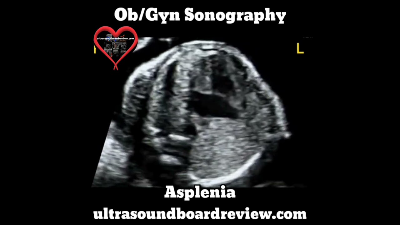 Asplenia Ultrasound