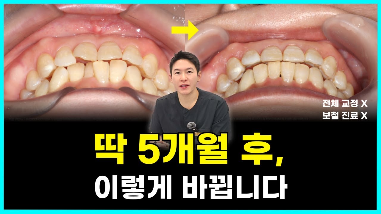 앞니 부분교정 5개월 증례｜치료 과정부터 전후 비교까지